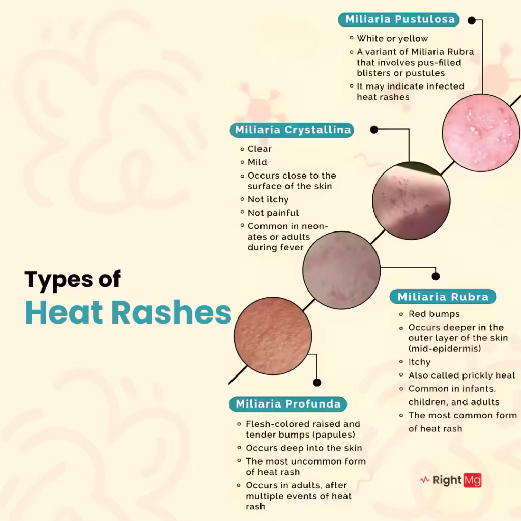 Types of heat rashes