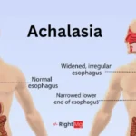 Achalasia (Esophagus Disorder): Symptoms, Causes and Treatment.