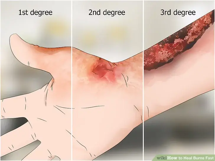 acid and chemical burns - Stages-of-Burning-Skin_Rightmg