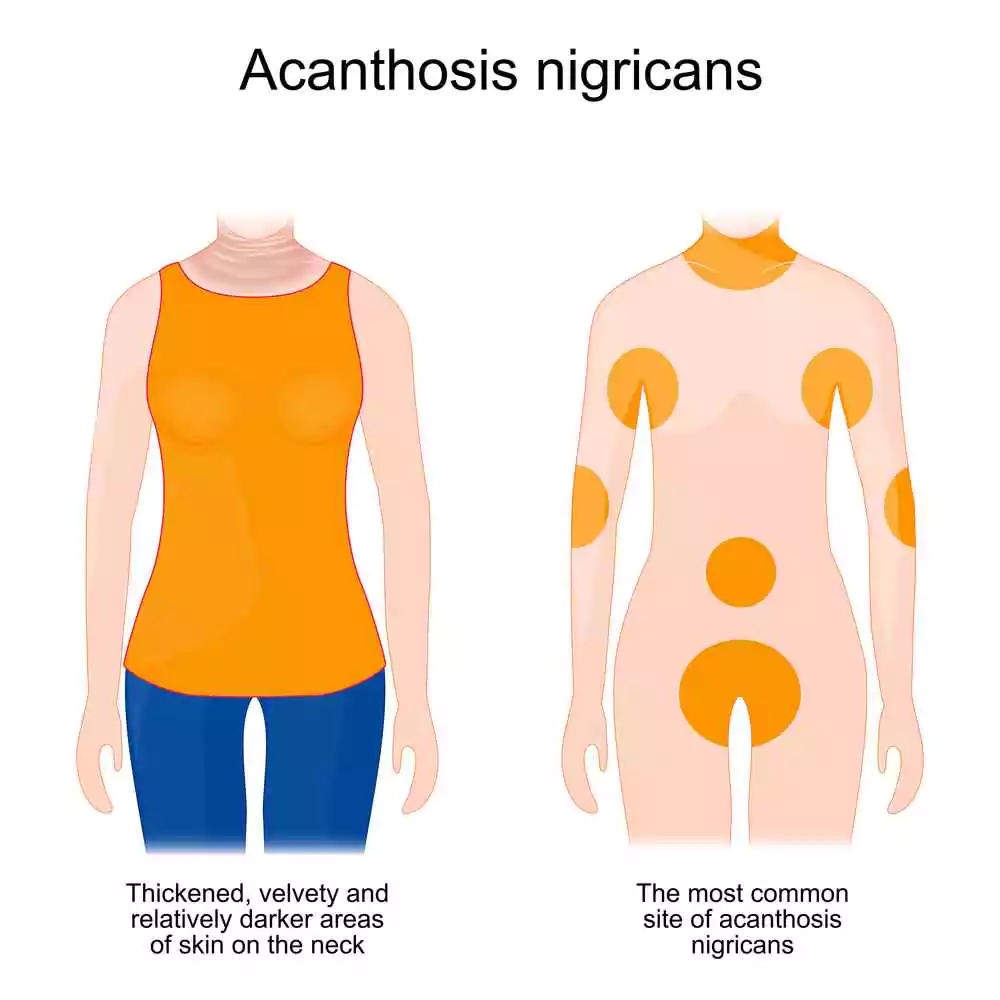 acanthosis-nigricans