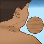 acanthosis-nigricans_Dark-neck